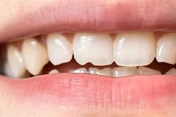 خوردن تخمه باعث فاصله افتادن بین دندان‌ها می‌شود؟