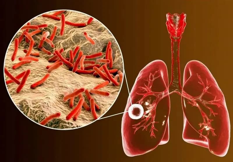 شیوع یک بیماری خطرناک در ایران؛ چند درصد از مبتلایان اتباع هستند؟