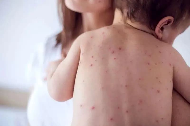 زنگ خطر شیوع مجدد سرخک به صدا درآمد