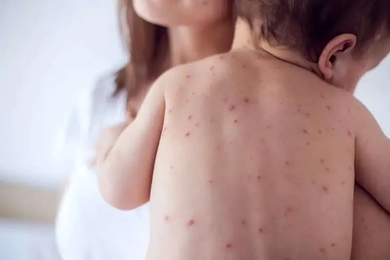 زنگ خطر شیوع مجدد سرخک به صدا درآمد