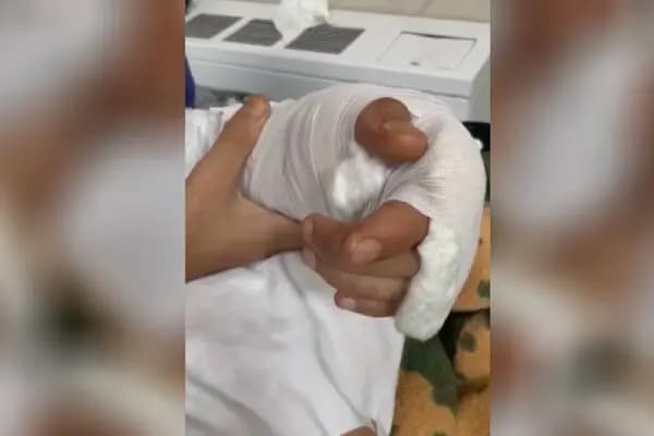 پیوند موفقیت آمیز دست قطع‌شده یک جوان زاهدانی